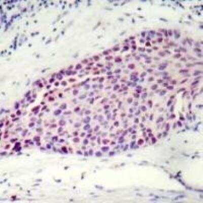 Immunohistochemistry-Paraffin: ATF2 [p Ser112, p Ser94] Antibody [NBP2-54641] - Immunohistochemical analysis of paraffin-embedded human breast carcinoma tissue using ATF2 [p Ser112, p Ser94]